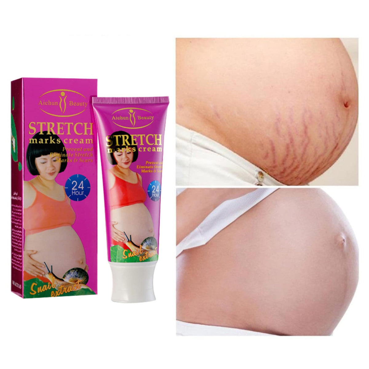 Snail Stretch Marks Cream